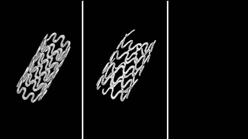 Researchers demonstrated the successful use of a completely biodegradable magnesium alloy tracheal stent (Credit: Materialise)
