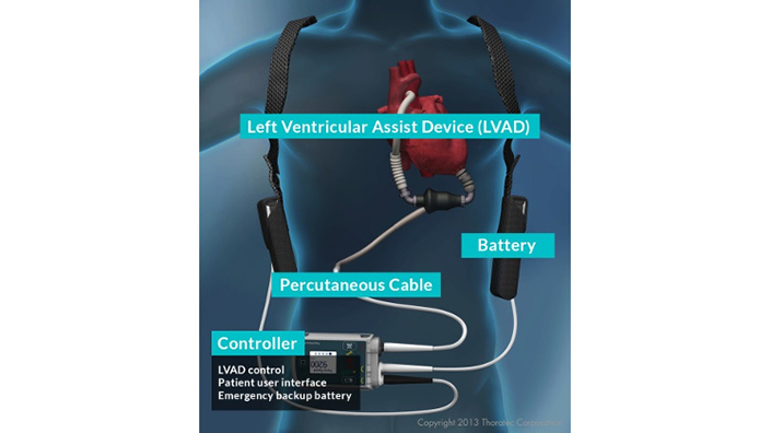 Figure 2. External Equipment of an LVAD. Image courtesy of Abbott Laboratories. 