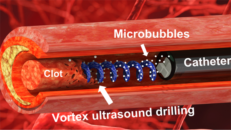 An illustration of how the vortex ultrasound can break down blood clots (Credit: Xiaoning Jiang and Chengzhi Shi)