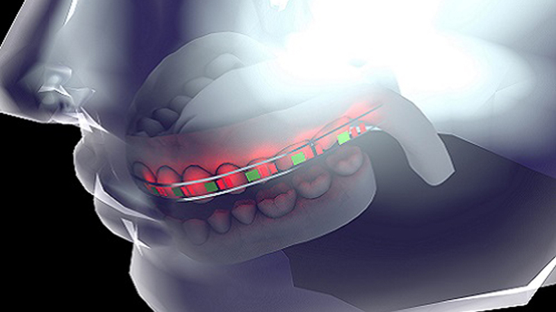 A concept image shows the 'smart' orthodontic brace (Credit: KAUST)